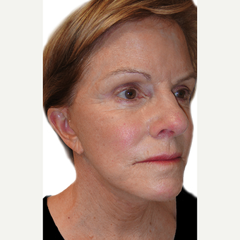 60 year old woman treated with Fat Transfer after 3409042