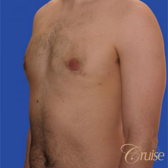 20 year old male had surgery to correct moderate gynecomastia and puffy nipple after 3196790