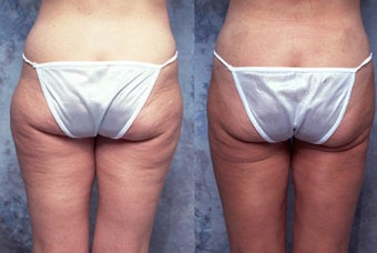 Tumescent body liposuction before 123113
