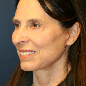 64 year old woman treated with Facelift after 3554093