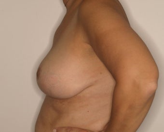 58 Year Old Female, 5ft 3 in, 147 lbs, with 36 HH cup breasts treated for large, sagging breasts. 1515412