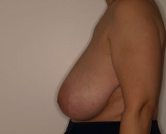 58 Year Old Female, 5ft 3 in, 147 lbs, with 36 HH cup breasts treated for large, sagging breasts. 1515412