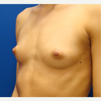 18-24 year old woman treated with Breast Implants before 3670831