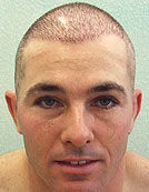 FUE – BHT SFET Using Head and Body Hair to add density before 195674