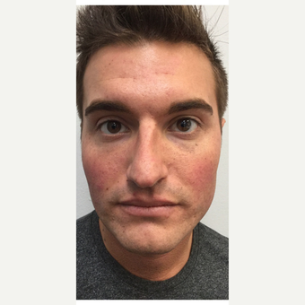 25-34 year old man treated with Dysport after 3787461