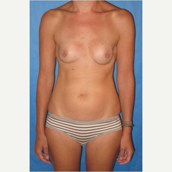 40 year old woman treated with nipple-sparing mastectomies and PAP flap Breast Reconstruction after 3724534