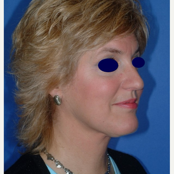 Rhinoplasty after 3325493