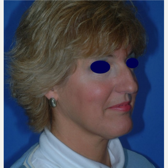 Rhinoplasty before 3325493