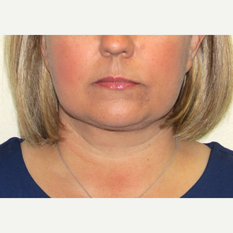 45-54 year old woman treated with Smart Lipo after 3802802