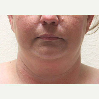 45-54 year old woman treated with Smart Lipo before 3802802