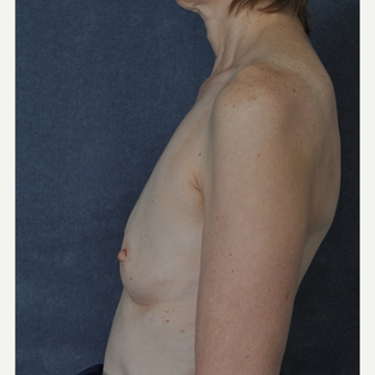 Breast Augmentation before 3816061