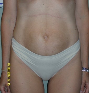 35-44 year old woman treated with Mini Tummy Tuck before 1745283