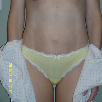 35-44 year old woman treated with Mini Tummy Tuck after 1745283