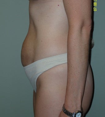 35-44 year old woman treated with Mini Tummy Tuck 1745283