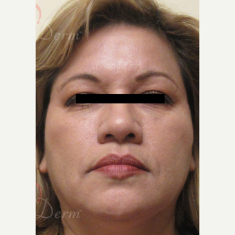 45-54 year old woman treated with Liquid Facelift after 3607998