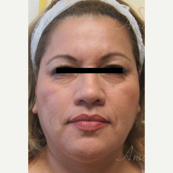 45-54 year old woman treated with Liquid Facelift before 3607998