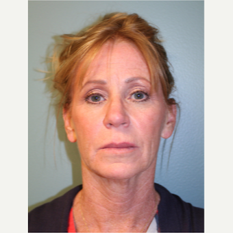 55-64 year old woman treated with Facelift before 3747641