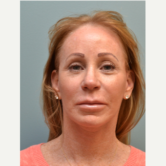 55-64 year old woman treated with Facelift after 3747641