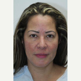 45-54 year old woman treated with Fat Transfer to the cheeks and lower lids before 3177384