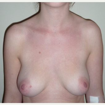 18-24 year old woman treated with Breast Augmentation before 3553416