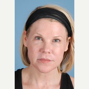 44 year old woman treated with Laser Resurfacing after 3839786