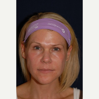 44 year old woman treated with Laser Resurfacing before 3839786
