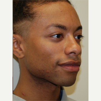 25-34 year old man treated with Silikon 1000 for permanent cheek augmentation after 3487857