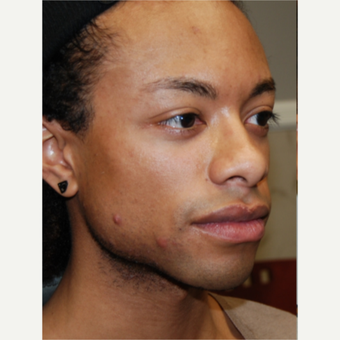 25-34 year old man treated with Silikon 1000 for permanent cheek augmentation before 3487857