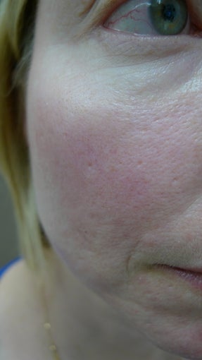 Acne Scars Treatment after 1514877