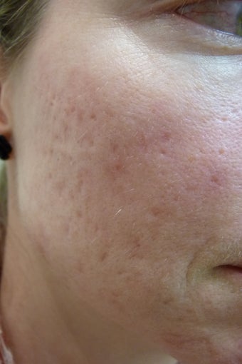 Acne Scars Treatment before 1514877
