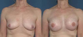 Breast & Nipple Reconstuction Status Post Areola and Nipple Tattoo before 1029116