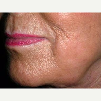 55-64 year old woman treated with Fraxel Laser before 2197933