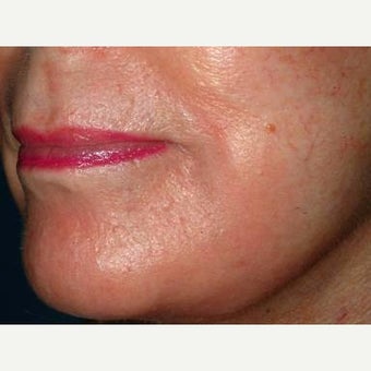 55-64 year old woman treated with Fraxel Laser after 2197933