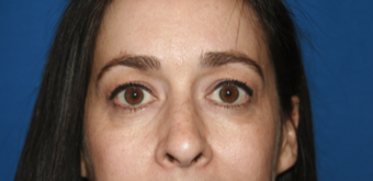 35-44 year old woman treated with Brow Lift before 3621137