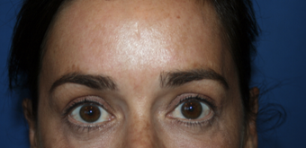 35-44 year old woman treated with Brow Lift after 3621137