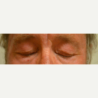 55-64 year old man treated with Eyelid Surgery before 3425570
