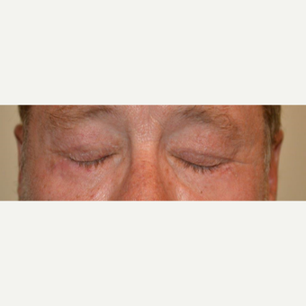 55-64 year old man treated with Eyelid Surgery after 3425570