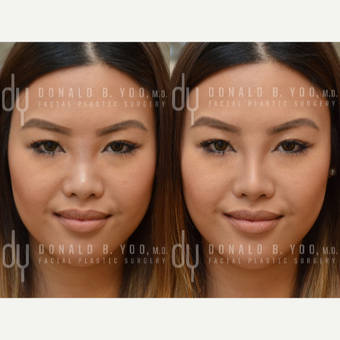 Non Surgical Rhinoplasty before 3322513