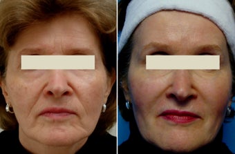 Sculptra before 1214294