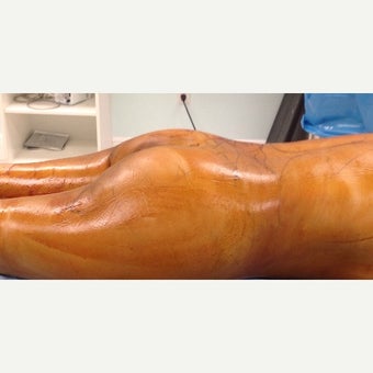 35-44 year old woman treated with Brazilian Butt Lift before 1784067