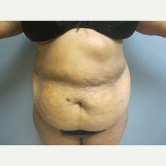 73 year old woman presents for a tummy tuck. She was tired of the over hanging skin. before 1635908