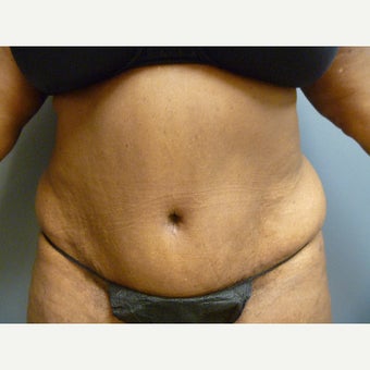 73 year old woman presents for a tummy tuck. She was tired of the over hanging skin. after 1635908