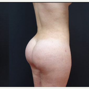 18-24 year old woman treated with Liposculpture after 3315573