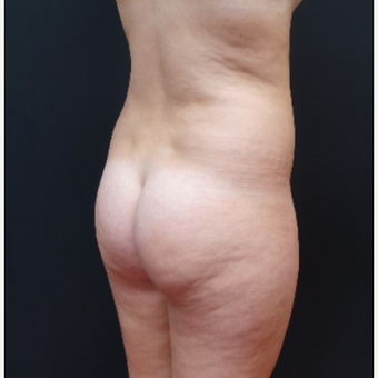 18-24 year old woman treated with Liposculpture before 3315573