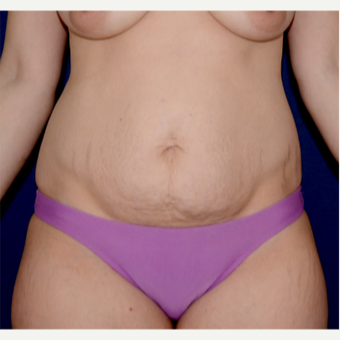 35-44 year old woman treated with Tummy Tuck, muscle repair, circumferential liposculpture before 2819594