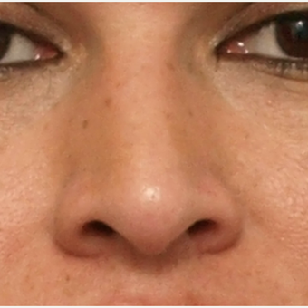 45-54 year old woman treated with Rhinoplasty before 3449099