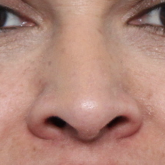 45-54 year old woman treated with Rhinoplasty after 3449099