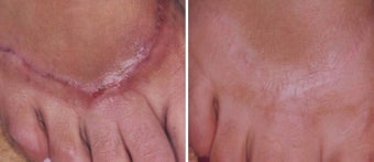 Before and After 1540 Laser Treatment of Hypertrophic Scar before 1094122