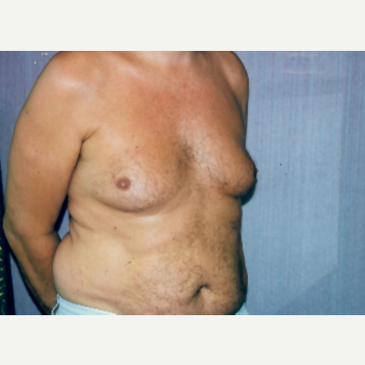 55-64 year old man treated with Male Breast Reduction before 3298168