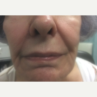 75 and up year old woman treated with Juvederm before 3175238